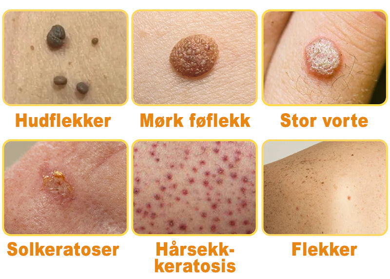 👔Turoment™ Bie Gift Behandlingskrem (🔥Siste dag, 80 % rabatt)