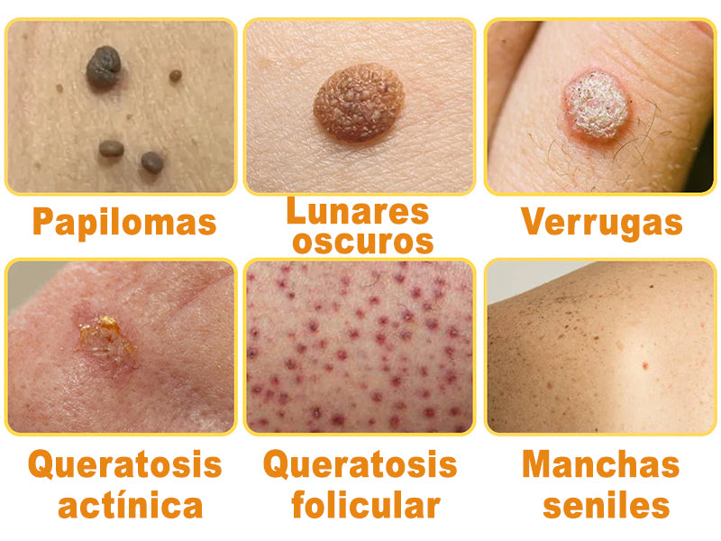 🎏Turonu™ Crema de Tratamiento con Veneno de Abeja (🔥Último día, 80 % de descuento)