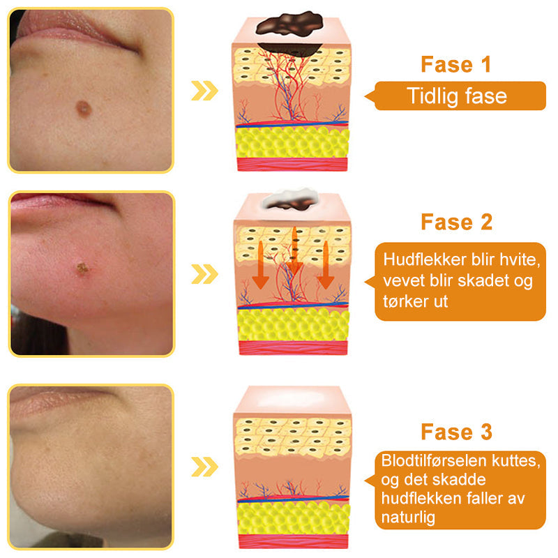 👔Turoment™ Bie Gift Behandlingskrem (🔥Siste dag, 80 % rabatt)