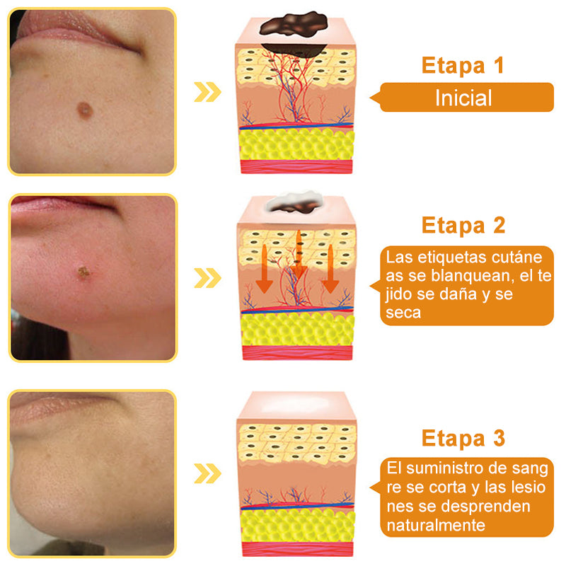 🎏Turonu™ Crema de Tratamiento con Veneno de Abeja (🔥Último día, 80 % de descuento)