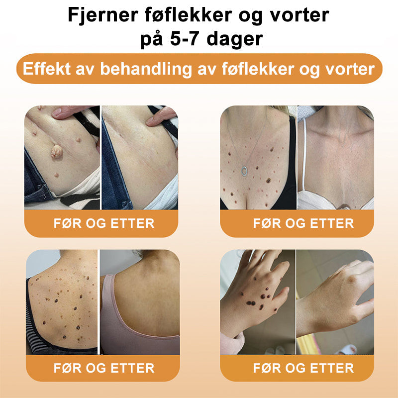 👔Turoment™ Bie Gift Behandlingskrem (🔥Siste dag, 80 % rabatt)