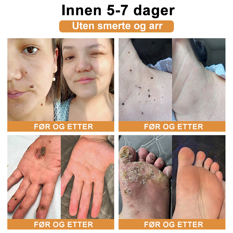 🦍Turoment™ Bie Gift Behandlingskrem (🔥Siste dag, 80 % rabatt)