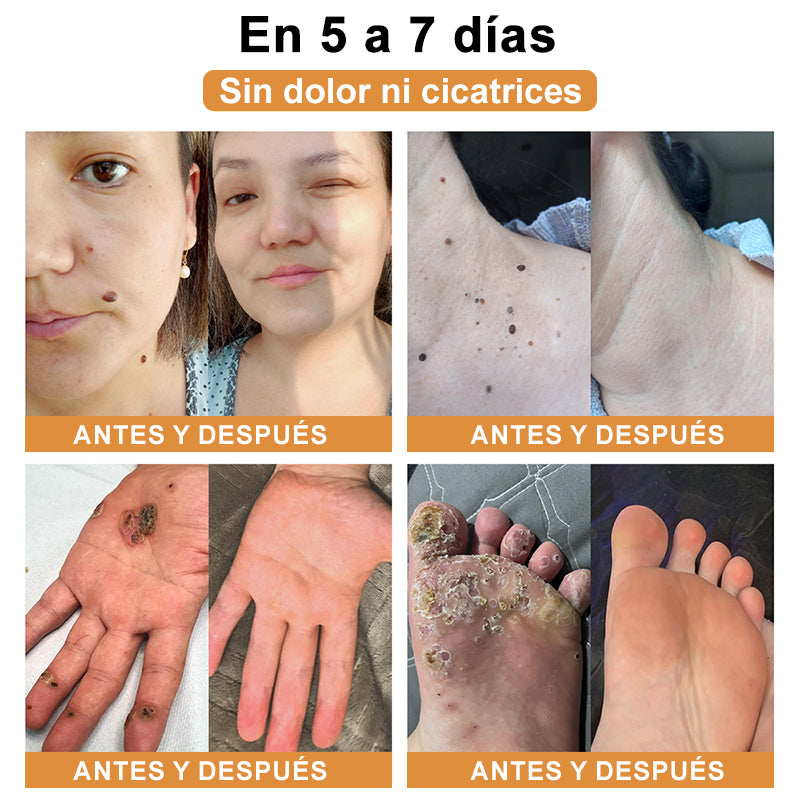 🎏Turonu™ Crema de Tratamiento con Veneno de Abeja (🔥Último día, 80 % de descuento)
